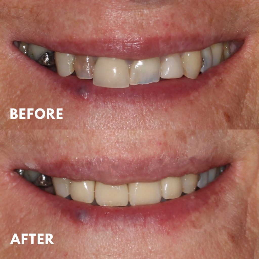 Upper Porcelain Veneers, Mornington Peninsula Dentist, Discoloured Teeth, Smile